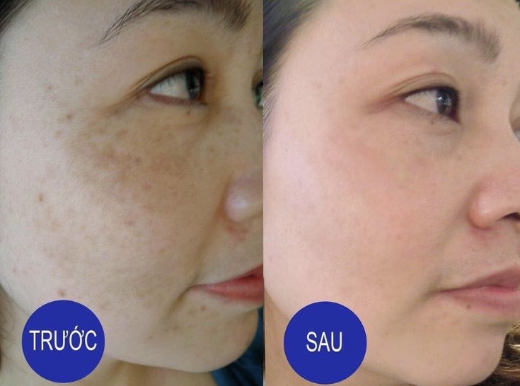 Bị nám tàn nhang lâu năm có chữa được không?