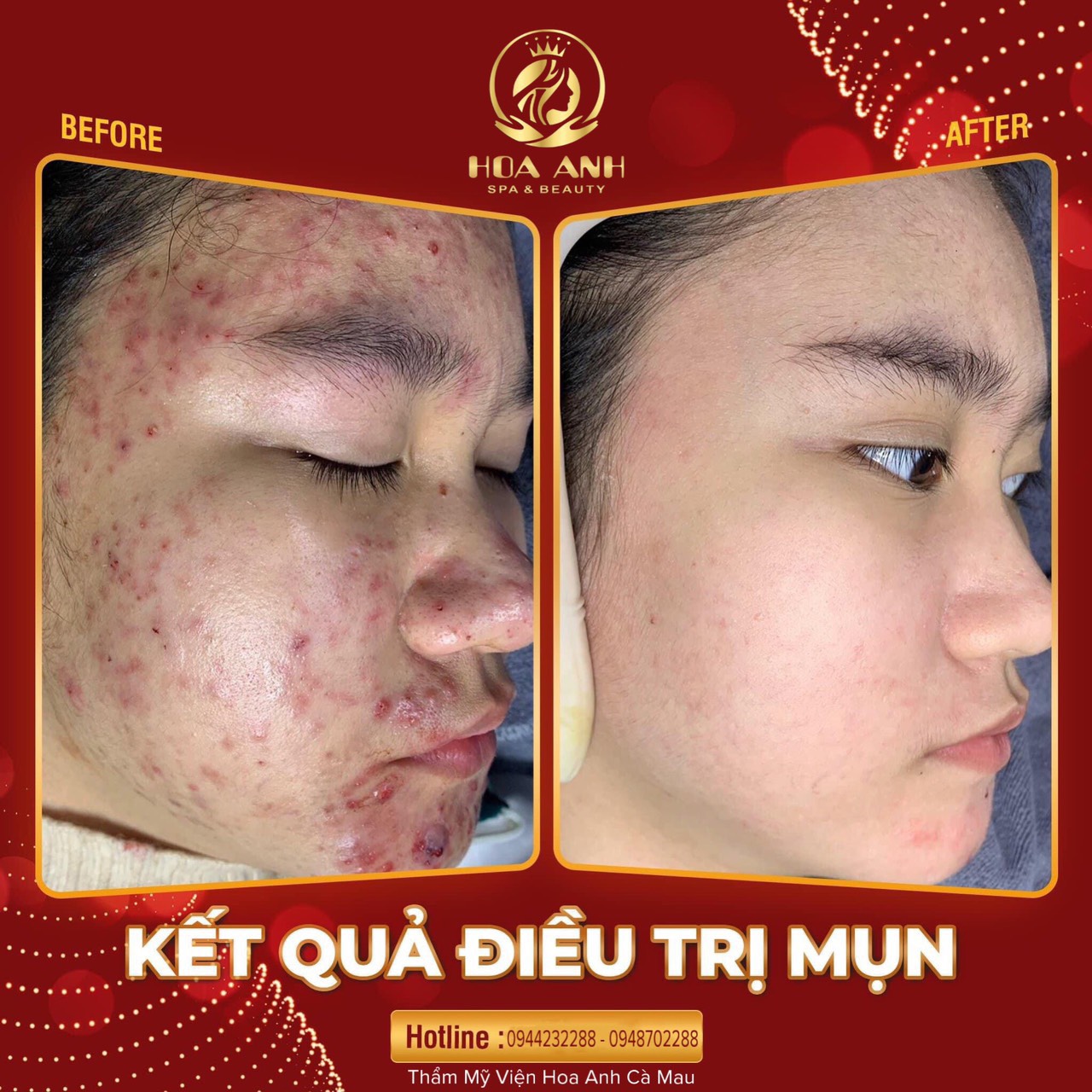 ĐIỀU TRỊ MỤN Tại Cà Mau