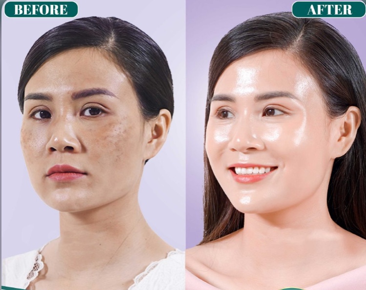 TIÊM MESOTHERAPY Tại Cà Mau