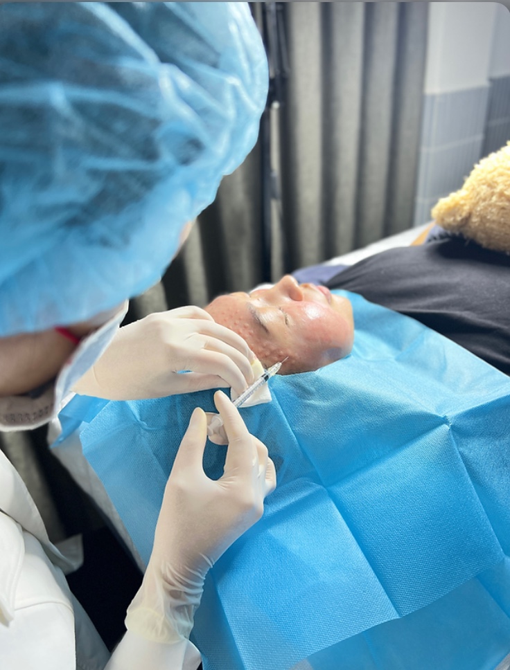 TIÊM MESOTHERAPY Tại Cà Mau