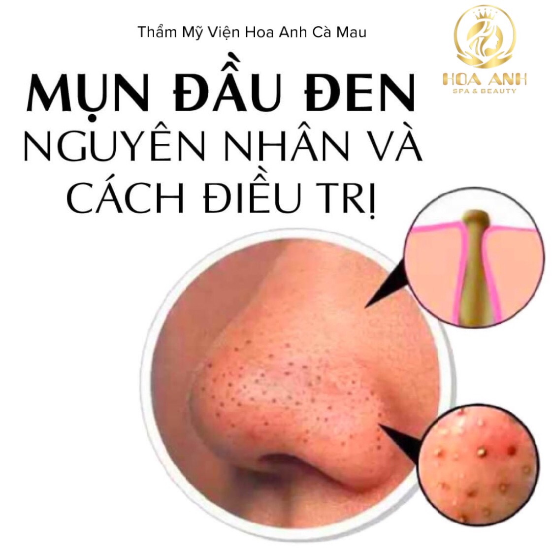 MỤN ĐẦU ĐEN - NGUYÊN NHÂN VÀ CÁCH ĐIỀU TRỊ Tại Hoa Anh Cà Mau