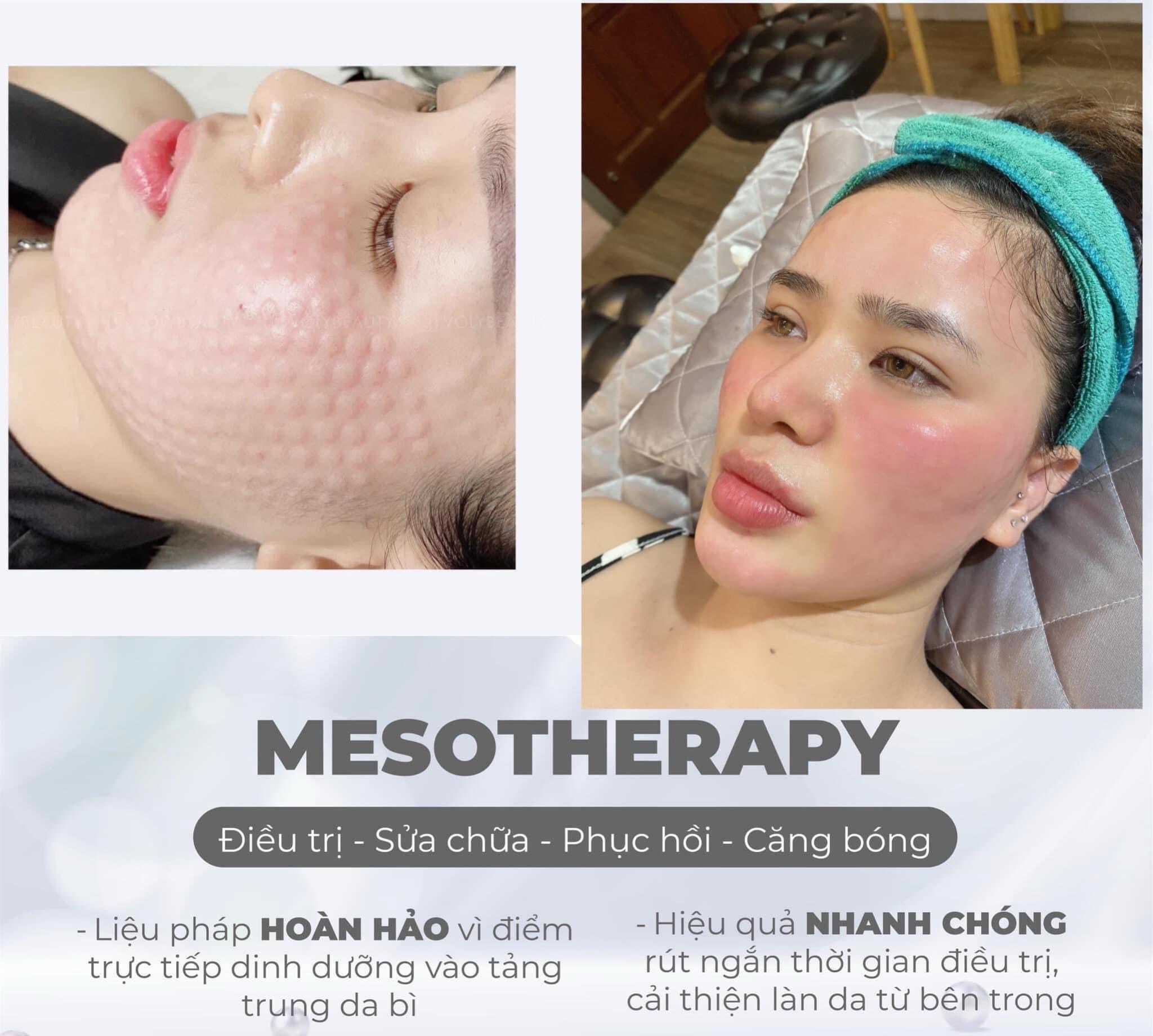 CẤY MESOTHERAPY  Tại Thẩm Mỹ Viện Hoa Anh Cà Mau
