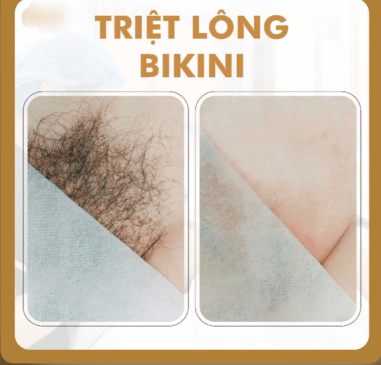 Triệt lông vùng kín