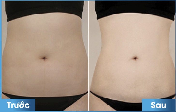 LIỆU TRÌNH GIẢM BÉO MAXTHINLIPO Tại Thẩm Mỹ Viện Hoa Anh Cà Mau