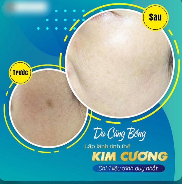 TRỊ LIỆU TRẮNG SÁNG KIM CƯƠNG CÔNG NGHỆ MESOTHERAPY TẠI CÀ MAU