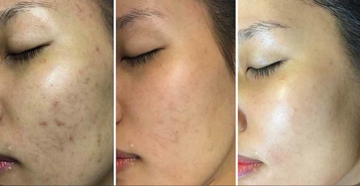 TRỊ LIỆU TRẮNG SÁNG KIM CƯƠNG CÔNG NGHỆ MESOTHERAPY TẠI CÀ MAU