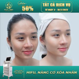 nâng cơ hifu xóa nhăn