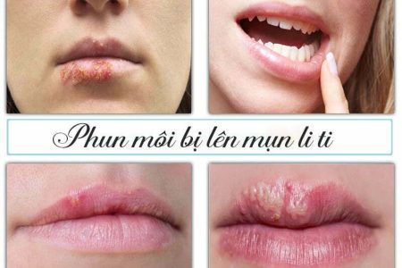 môi bị nổi mụn nước sau khi phun