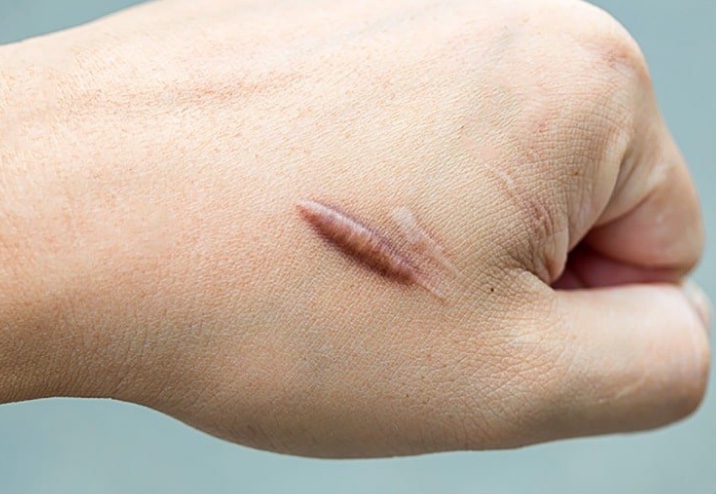 Với một số loại sẹo lồi, bác sĩ sẽ tư vấn cho bạn điều trị bằng laser.