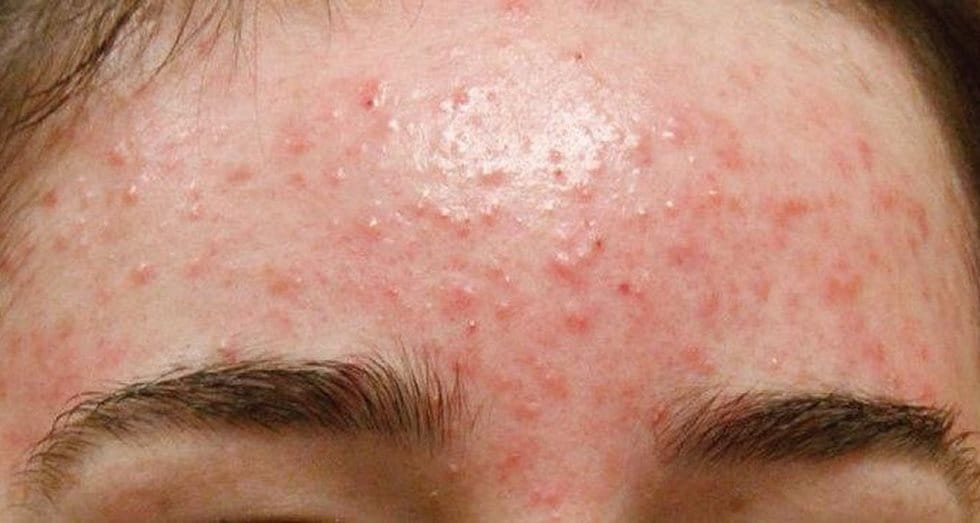 Mụn ẩn mọc thành từng cụm, dày đặc, với kích thước nhỏ li ti