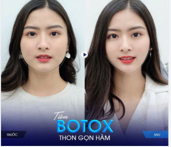 tiêm botox thon gọn hàm