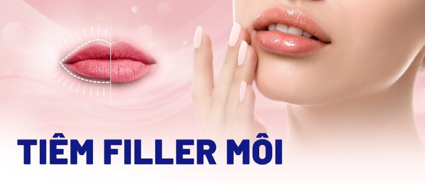tiêm filler môi