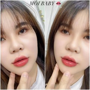 tiêm môi baby căng mọng