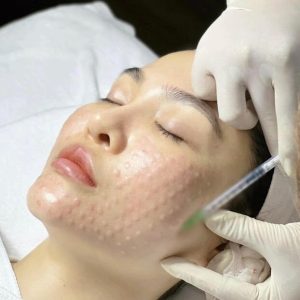 cấy meso cho làn da căng bóng