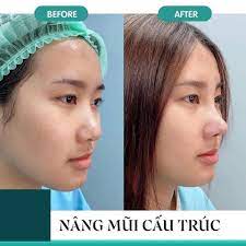 filler nâng chỉnh dáng mũi