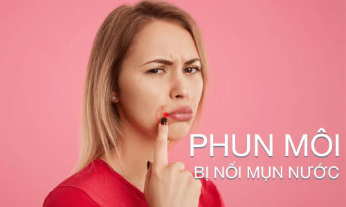 phun môi bị nổi mụn nước