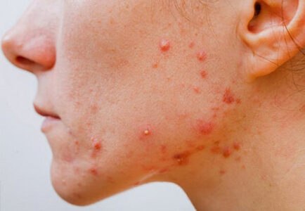 mụn viêm trên da