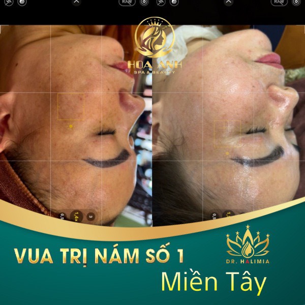 thẩm-mỹ-hoa-anh