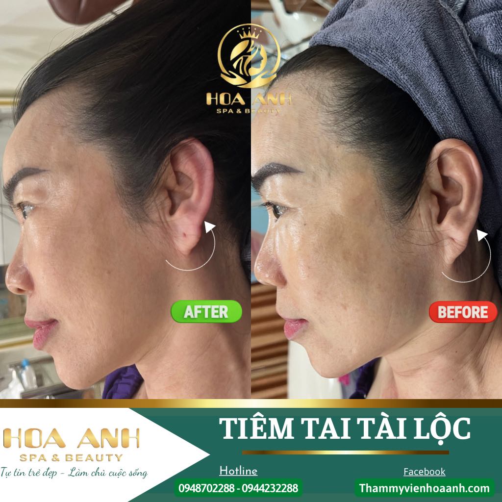 thẩm-mỹ-hoa-anh