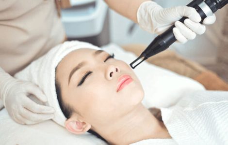 điều trị tàn nhang bằng laser