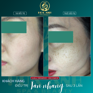 điều trị tàn nhang tại Hoa Anh