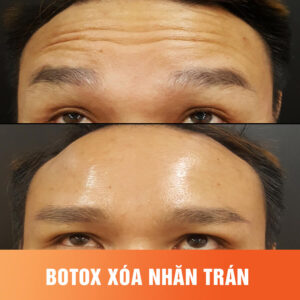 xóa nhăn trán bằng botox