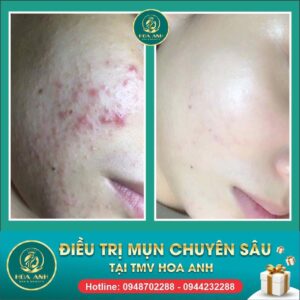 điều trị mụn