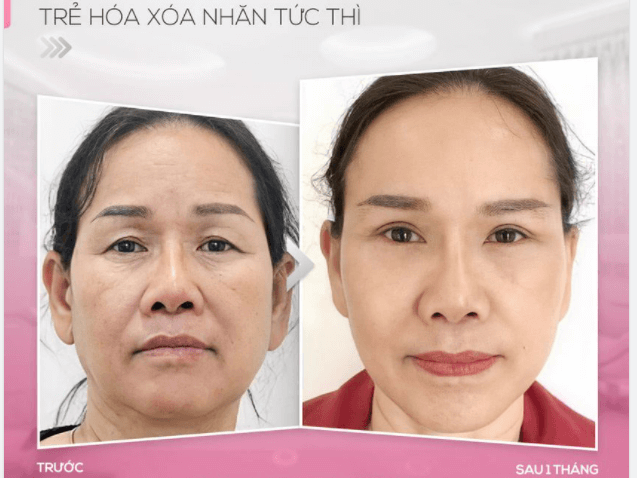 nâng cơ hifu