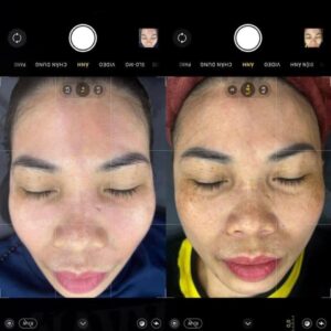 điều trị nám bằng laser