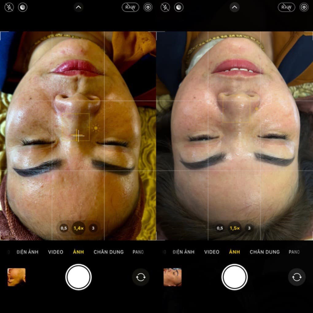 điều trị nám bằng laser