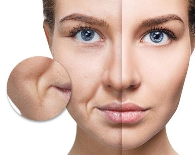 xóa rãnh cười