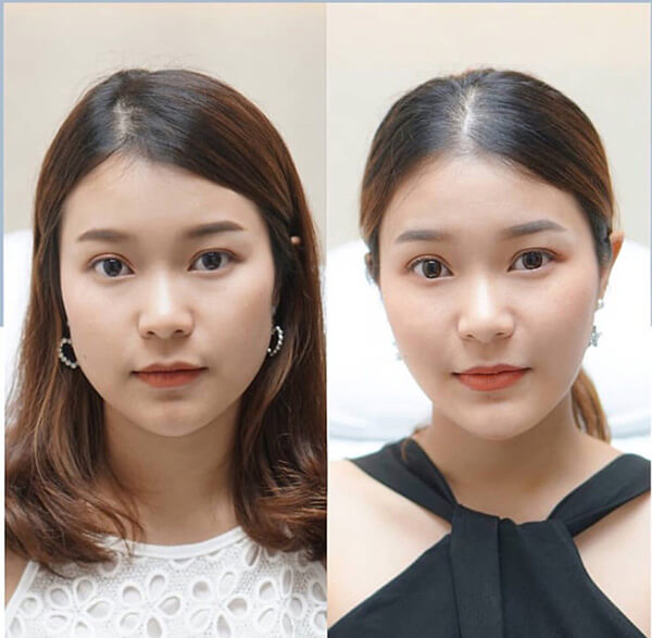 tiêm botox thon gọn hàm