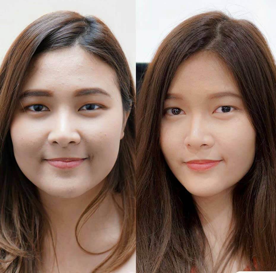 tiêm botox thon gọn hàm