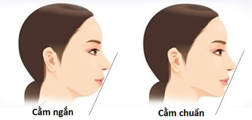 tiêm cằm vline