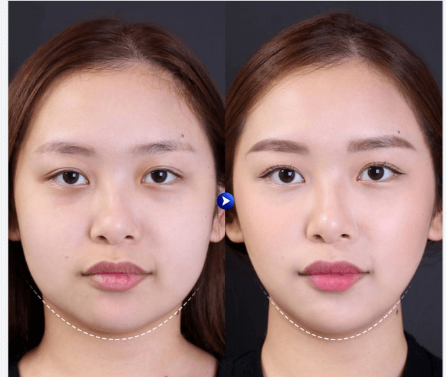 tiêm botox thon gọn hàm