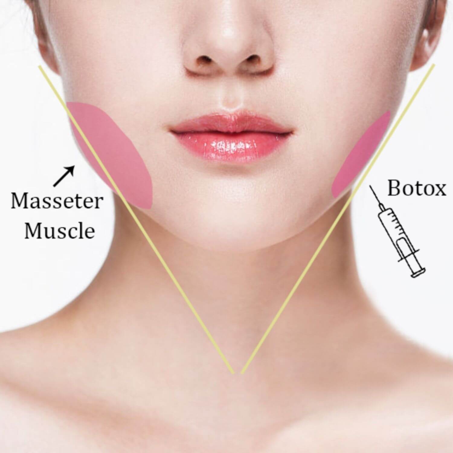 tiêm botox thon gọn hàm
