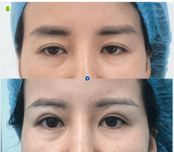 nâng cung chân mày