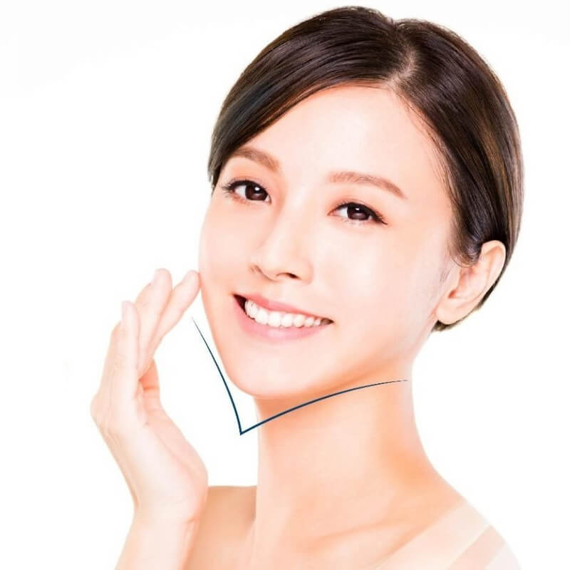 tiêm cằm vline