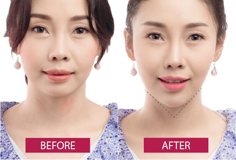 tiêm cằm vline