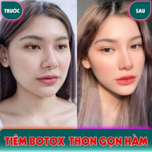 tiêm botox thon gọn hàm