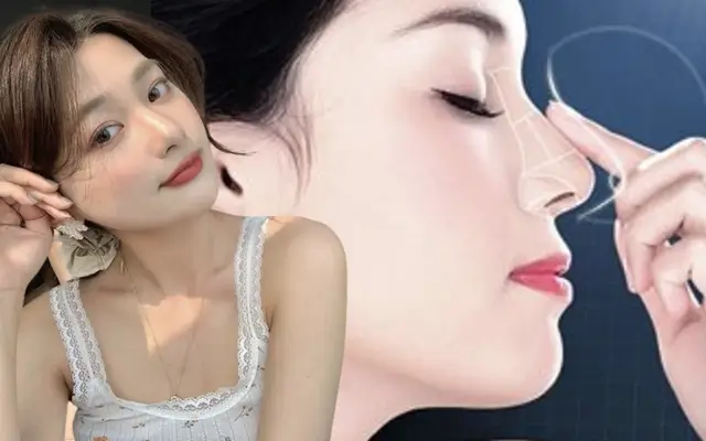 nâng mũi chỉ collagen