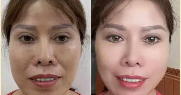 nâng cơ xóa nhăn rãnh cười