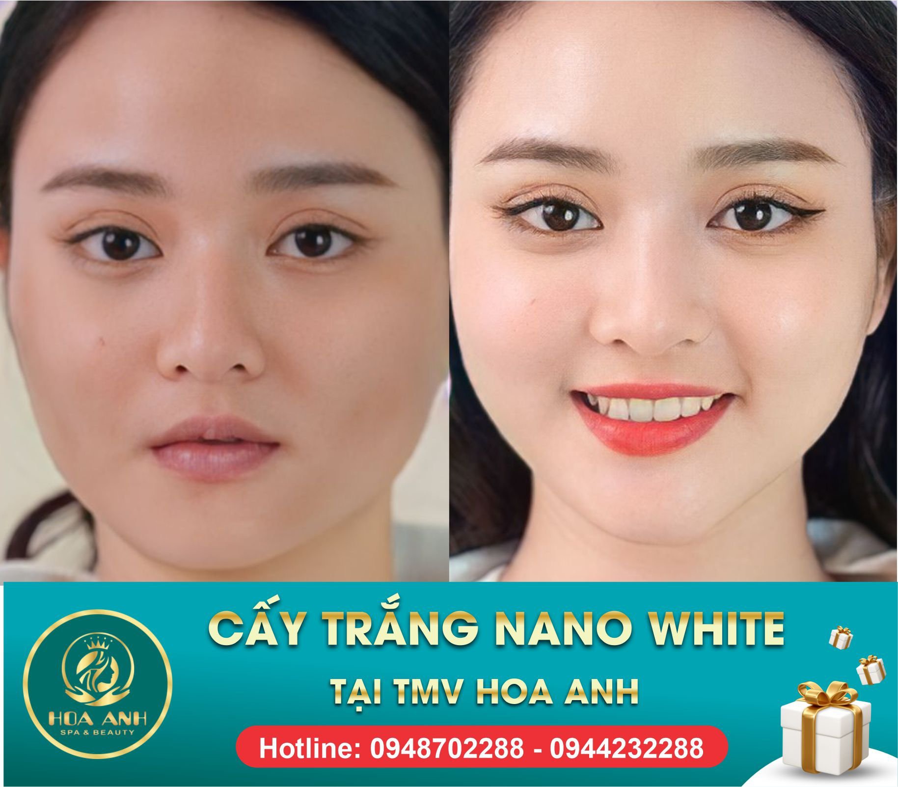 trước và sau cấy trắng collagen