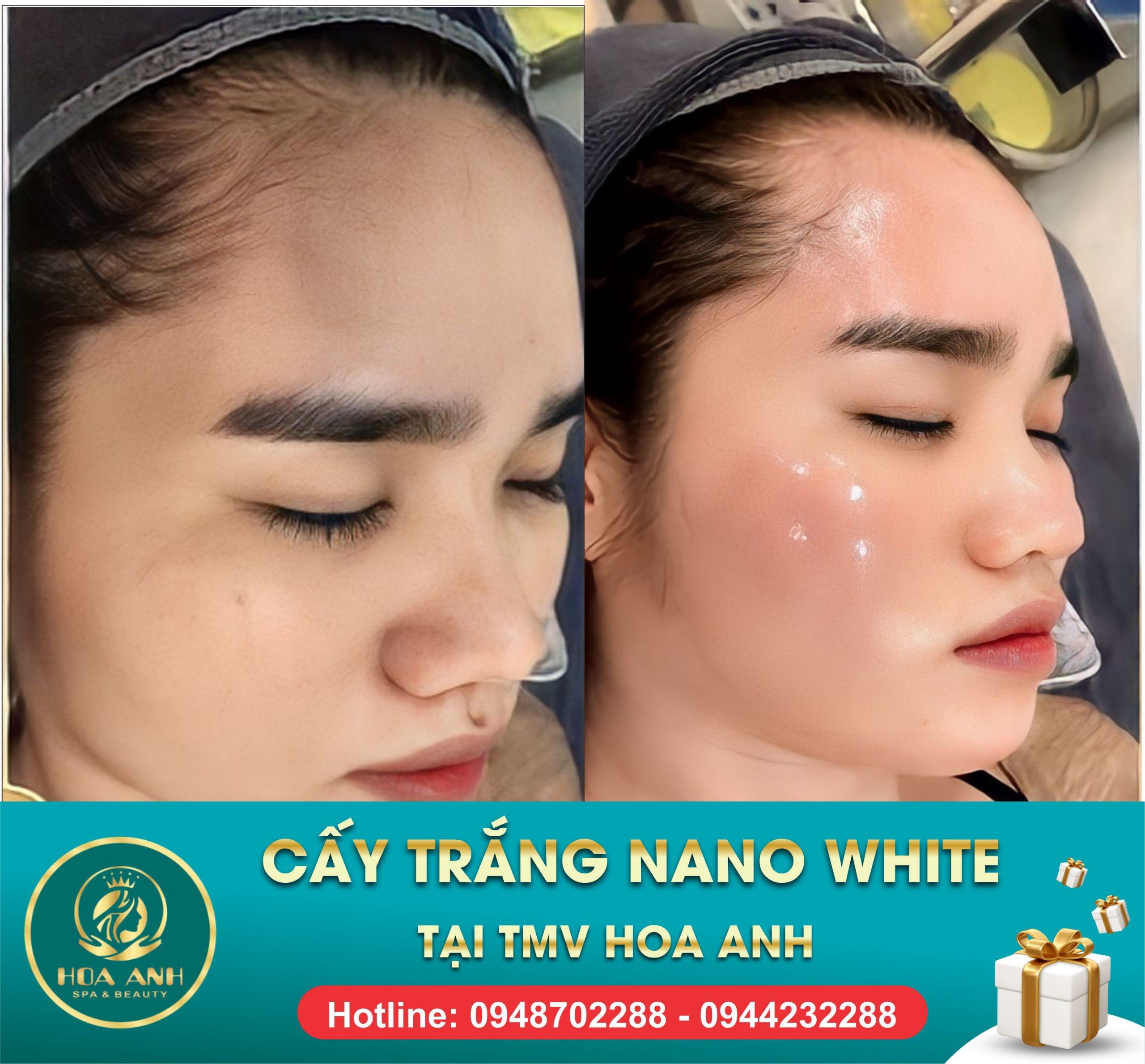 trước và sau cấy trắng collagen