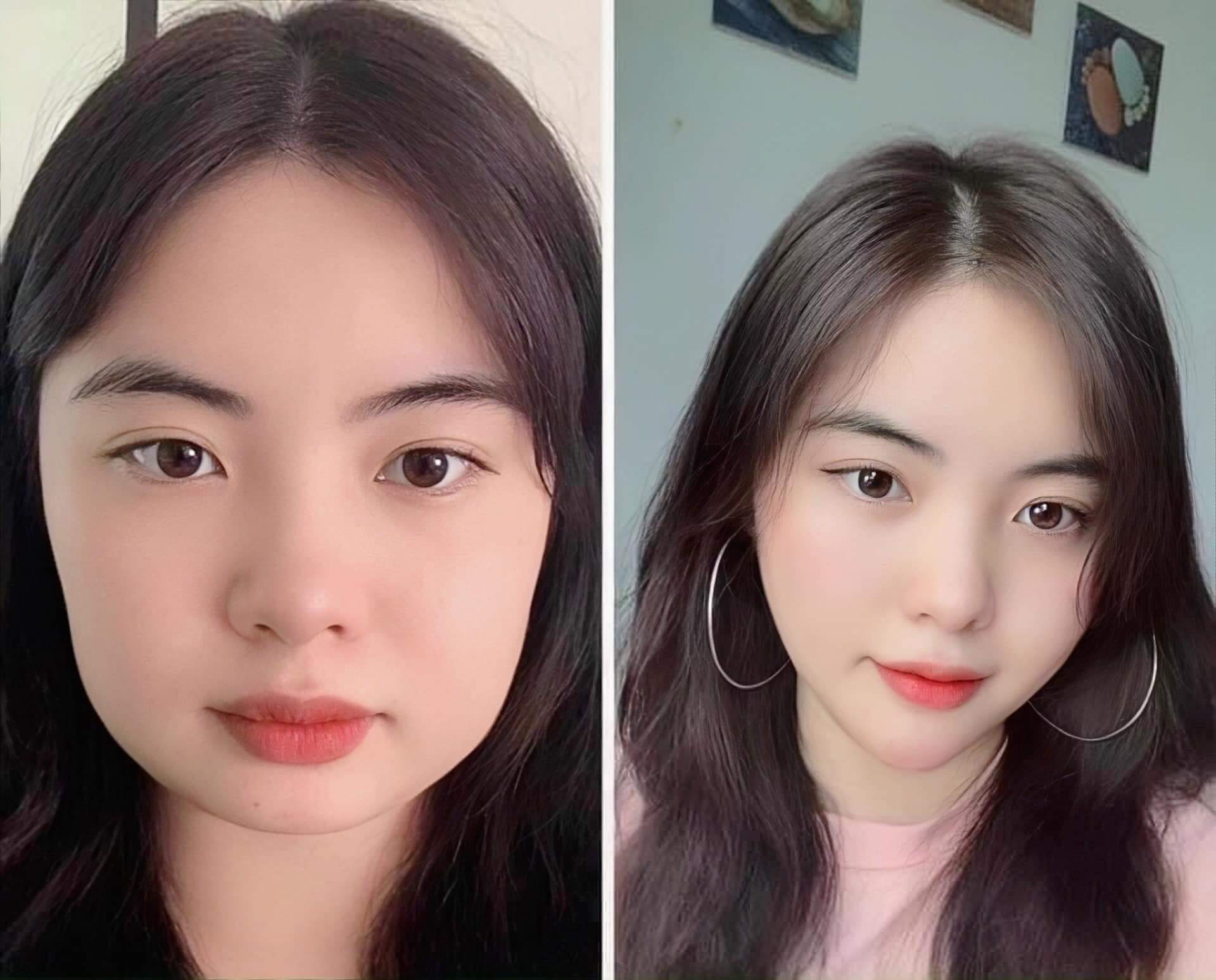 tiêm cằm vline