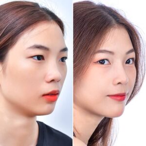 nâng mũi chỉ collagen