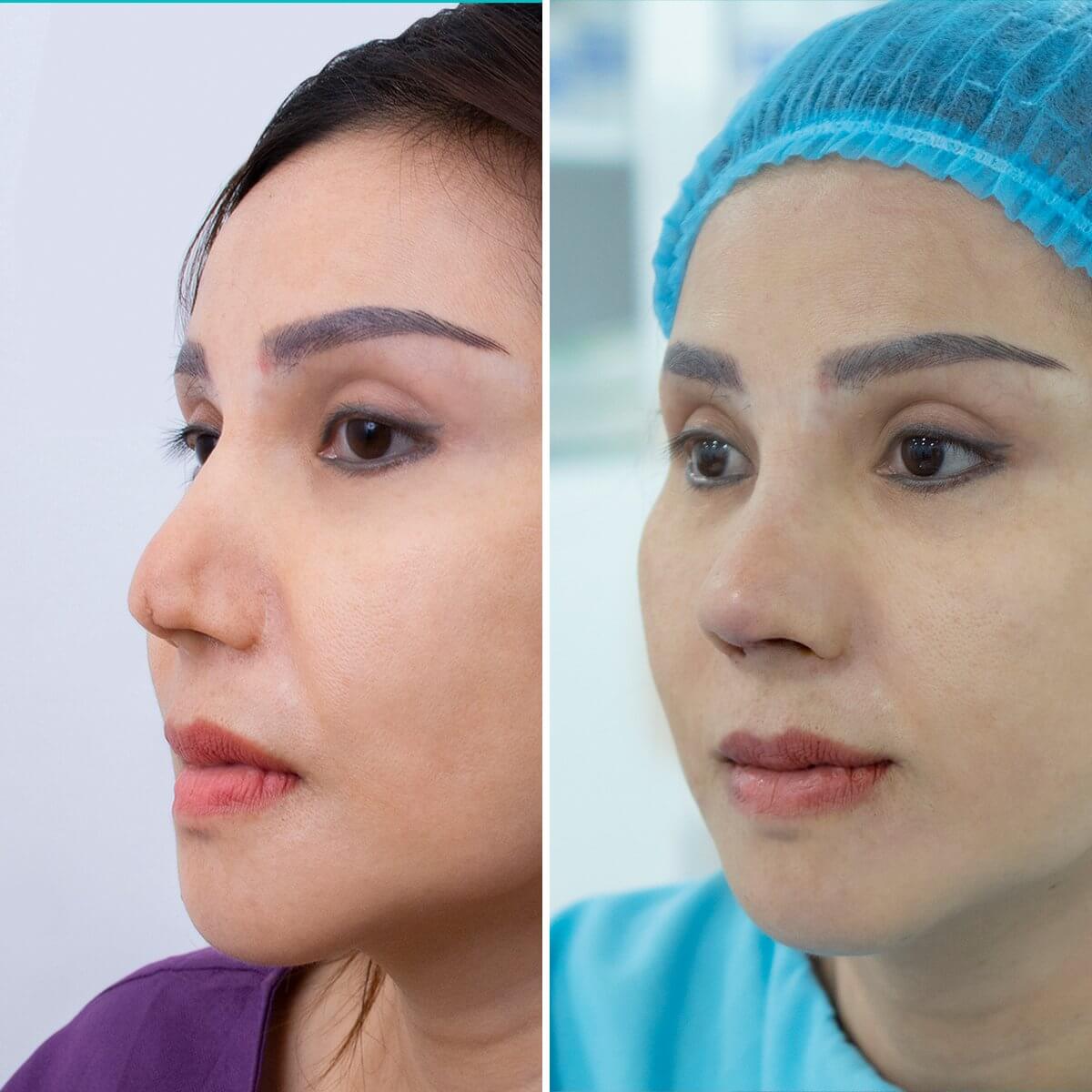 nâng mũi chỉ collagen