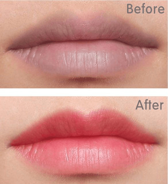 xử lý thâm môi bằng laser