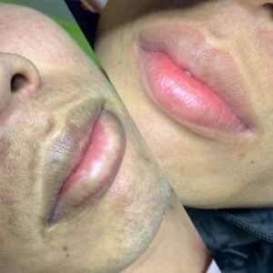 thâm môi cơ địa