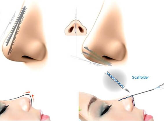 nâng mũi chỉ collagen